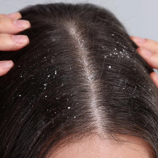 Dandruff